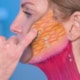 Illustration of facial retaining ligaments and platysma muscle showing how ligament release improves jawline and neck contour in a deep plane facelift