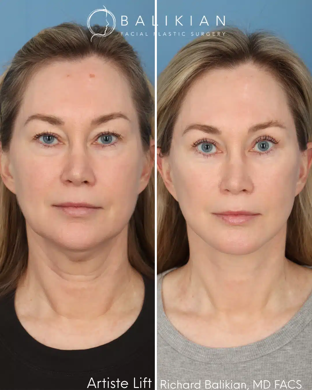 Front view before and after deep plane facelift showing improved facial symmetry, volume restoration, and natural rejuvenation
