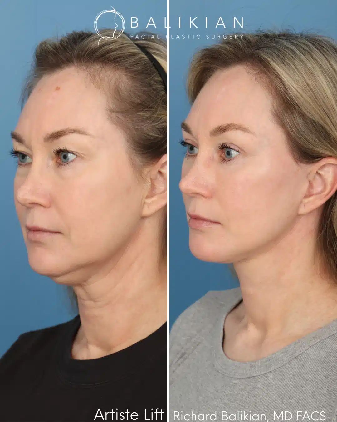 Left oblique before and after deep plane facelift and neck lift with improved jawline contour and midface volume