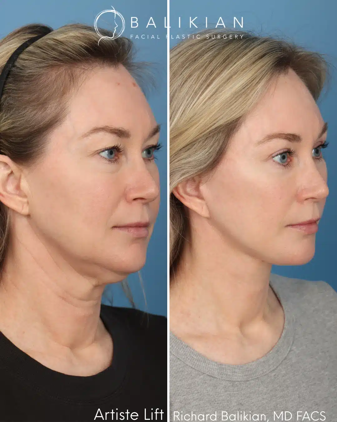 Right oblique before and after deep plane facelift with lifted cheeks, refined jawline, and smoother contour