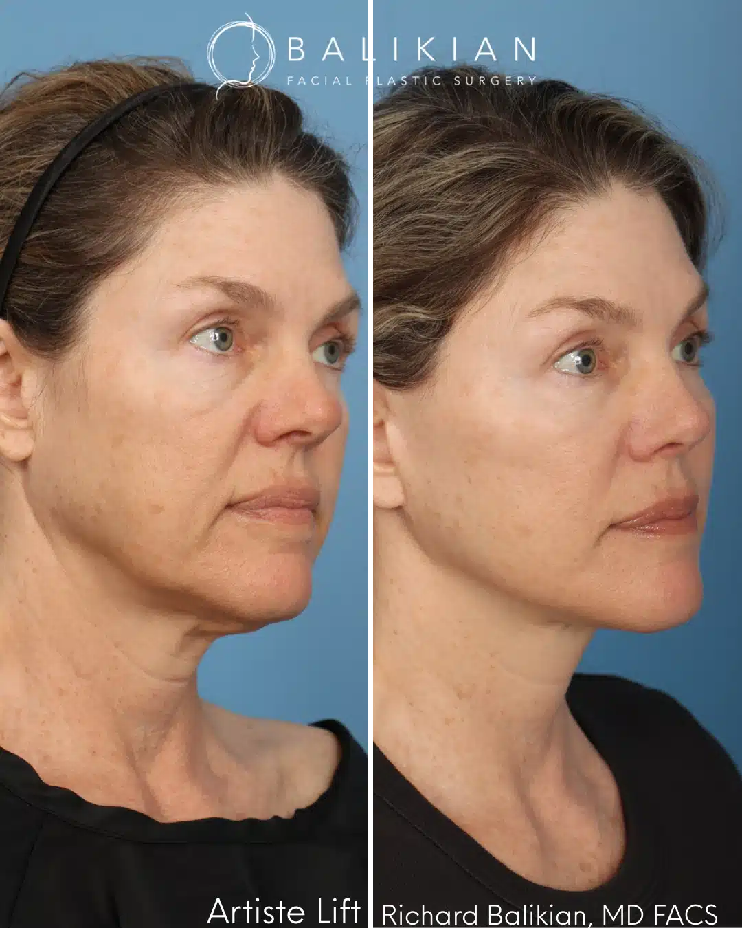 Right oblique before and after deep plane facelift with lifted cheeks, refined jawline, and smoother skin