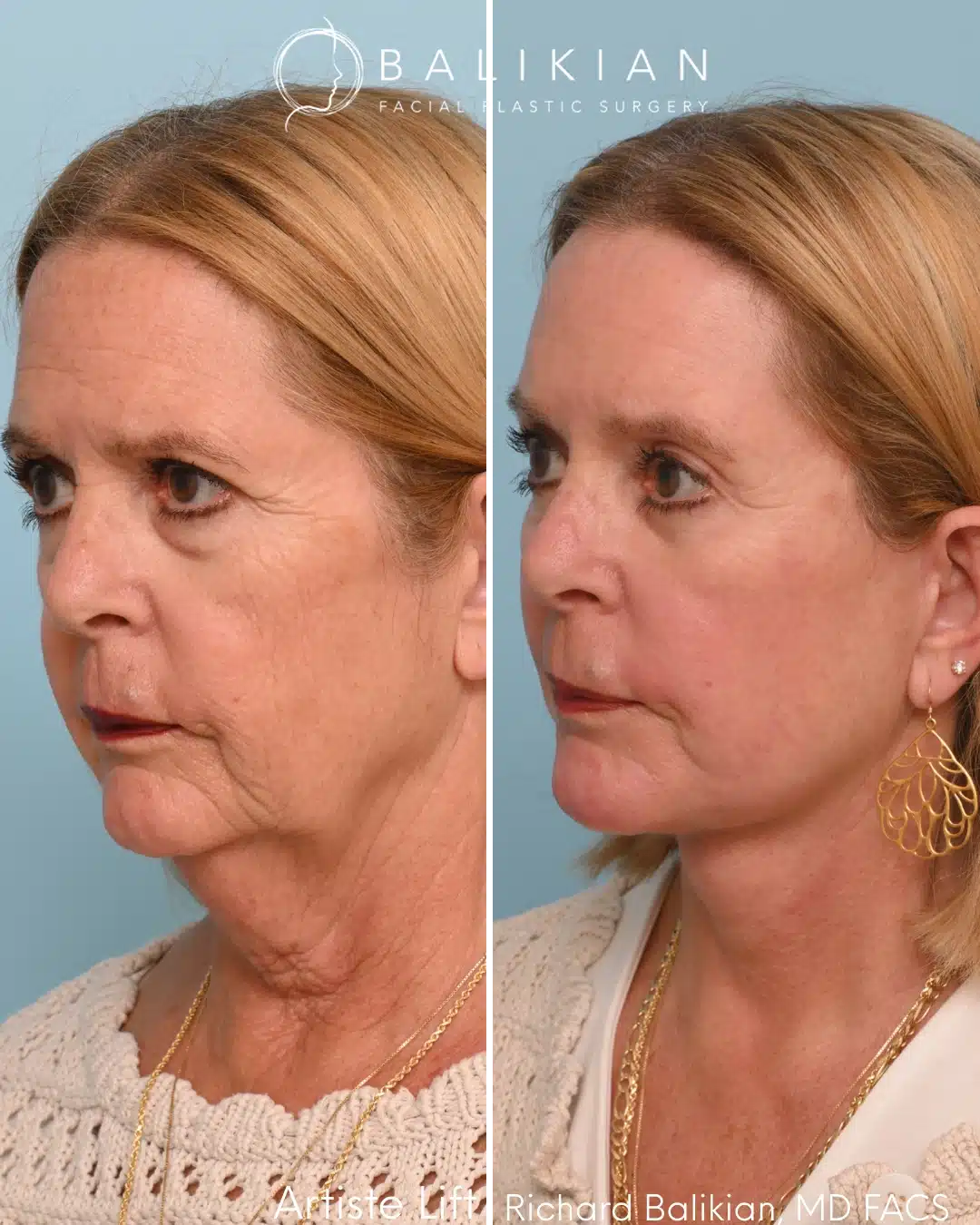 Left oblique before and after deep plane facelift showing lifted cheeks, reduced jowls, and improved jawline contour