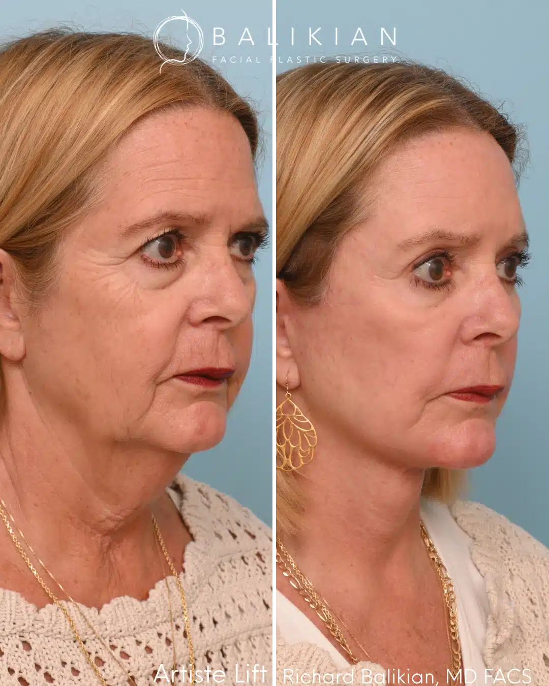 Right oblique before and after deep plane facelift with neck lift showing improved contour and smoother facial lines