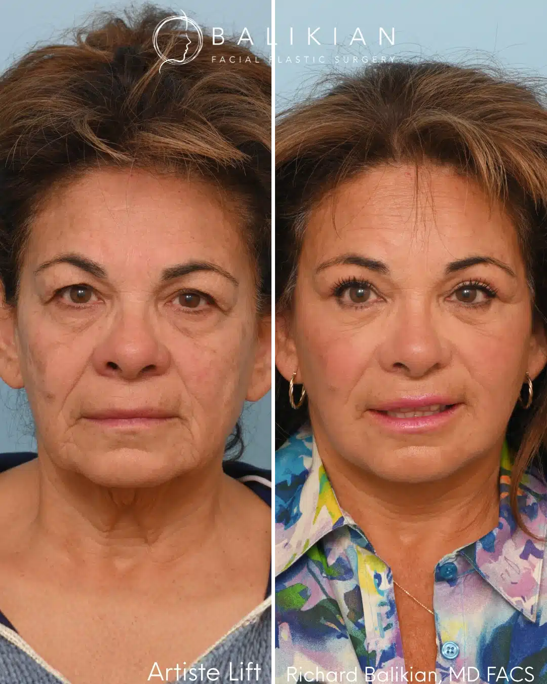 Front view before and after deep plane facelift with neck lift and eyelid surgery showing improved symmetry and facial rejuvenation