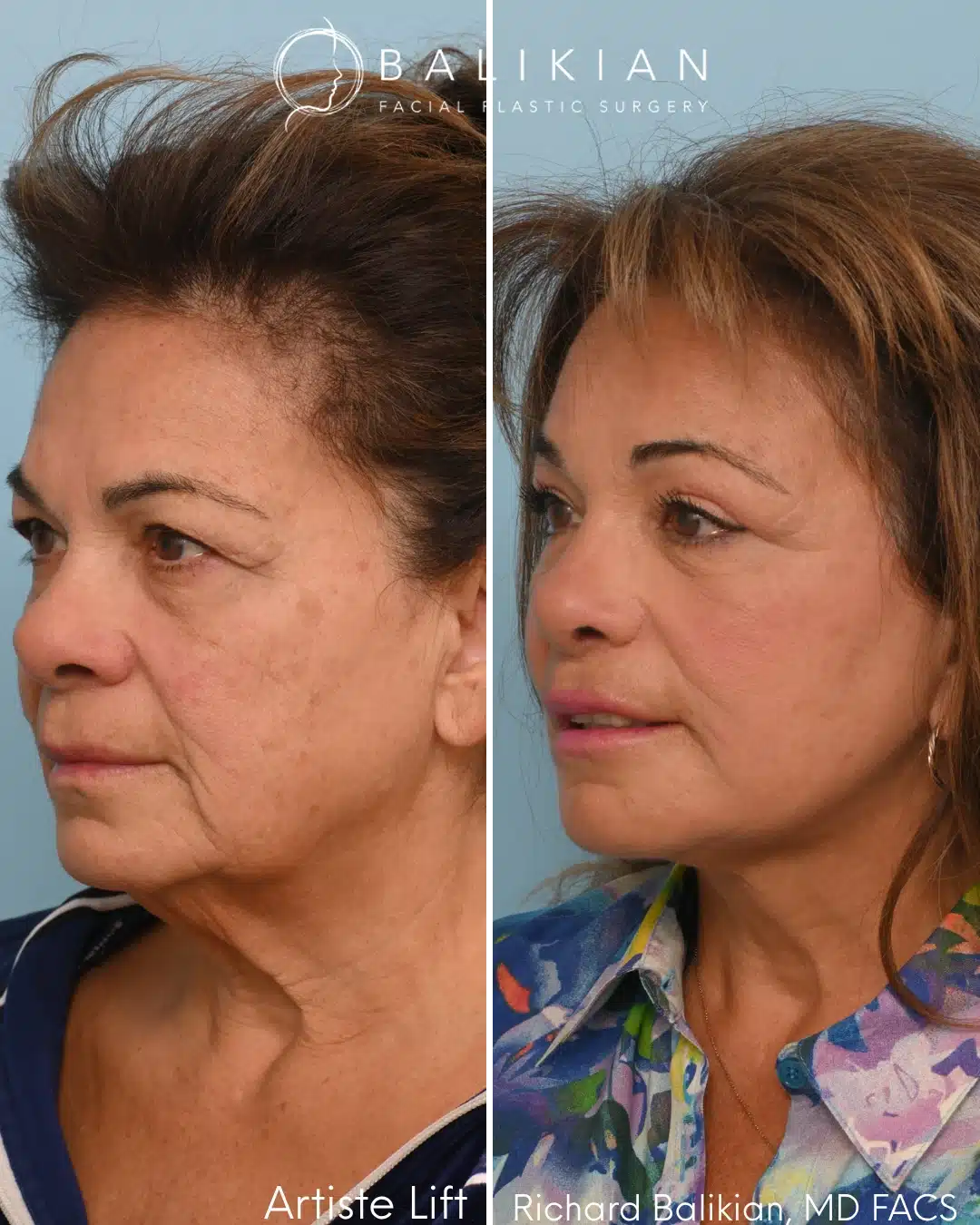 Left oblique before and after deep plane facelift showing lifted cheeks, reduced jowls, and improved jawline contour