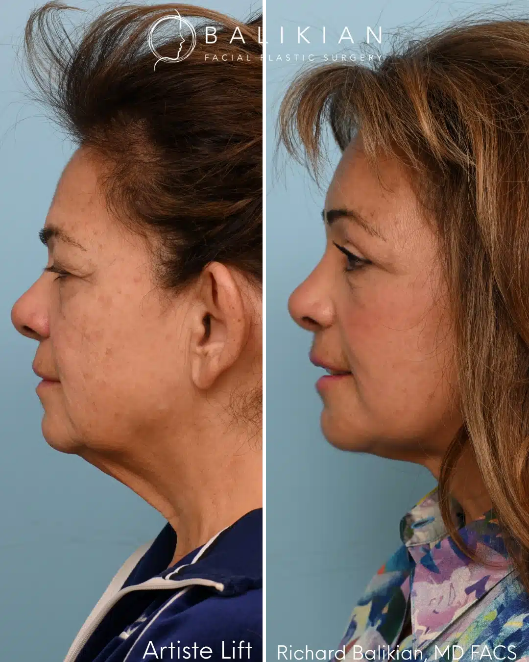 Left profile before and after deep plane facelift and neck lift showing improved neck contour and jawline definition