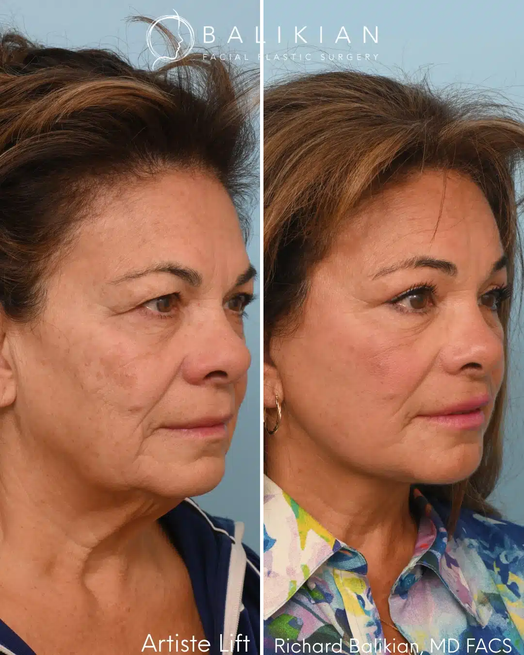 Right oblique before and after deep plane facelift with neck lift showing smoother contours and improved facial definition