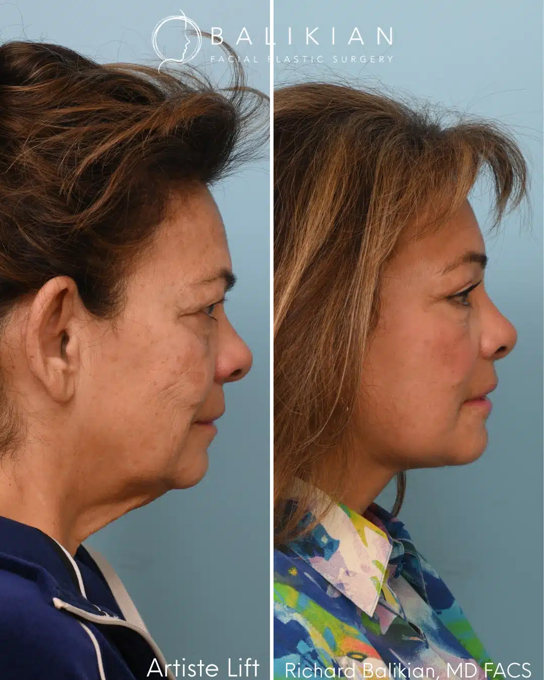 Right profile before and after deep plane facelift showing refined neckline and natural facial rejuvenation