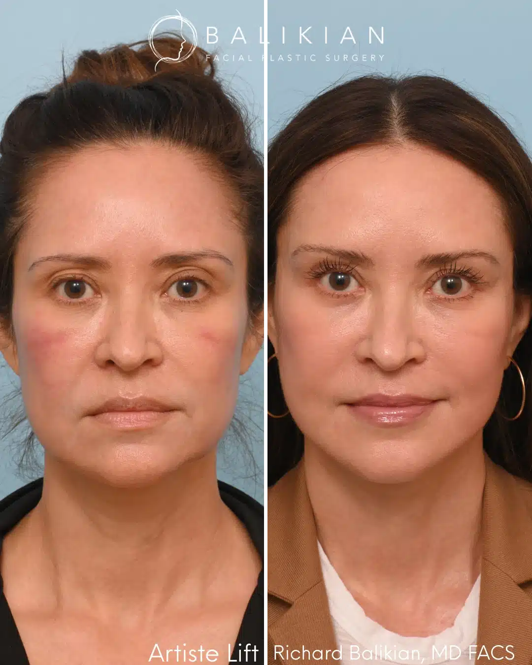 This Artiste Lift™ approach addresses multiple layers of aging with deep plane lifting, neck contouring, and volume restoration. Subtle improvements in symmetry, contour, and skin quality create a refreshed appearance without altering identity. Front view before and after deep plane facelift showing improved facial symmetry and natural rejuvenation
