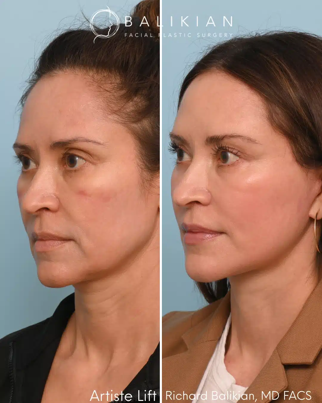 Left oblique before and after deep plane facelift and neck lift with improved jawline contour and facial balance