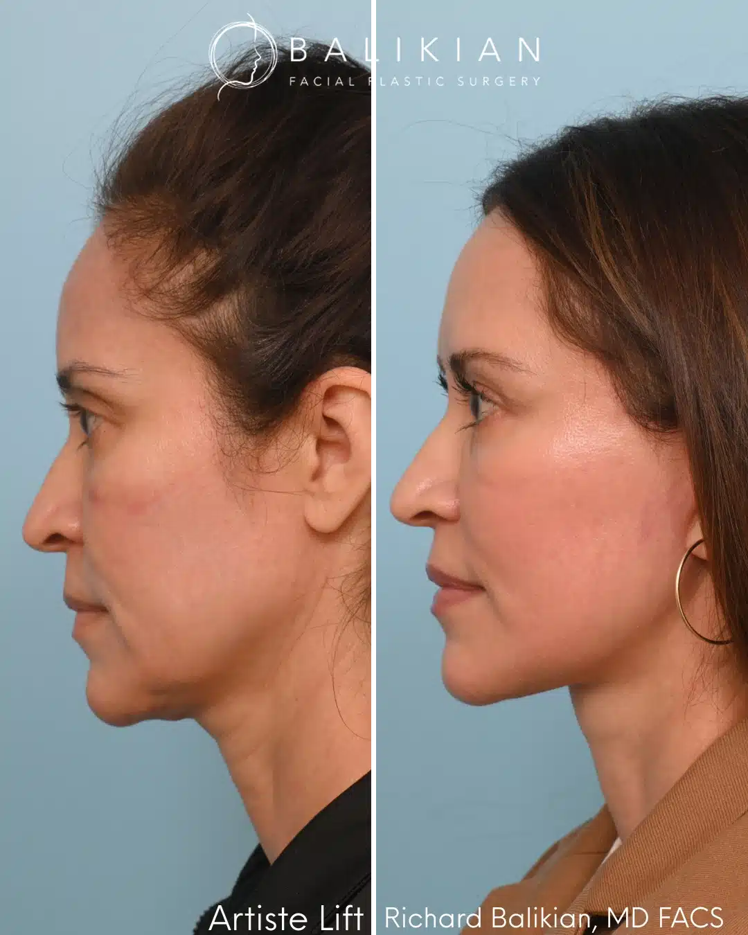 Left profile before and after deep plane facelift showing refined jawline and smoother neck contour