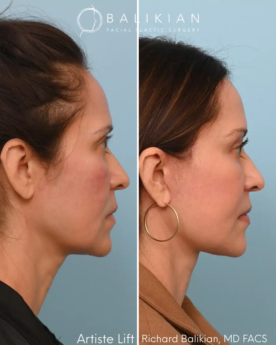Right profile before and after deep plane facelift showing improved neck contour and jawline definition