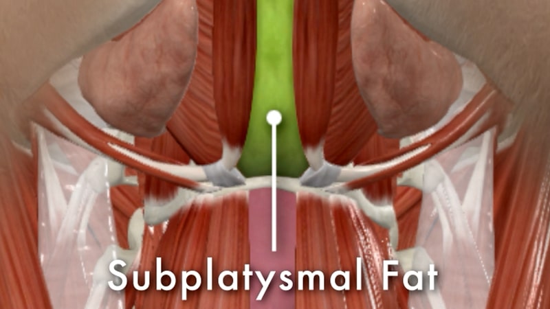 Subplatysmal fat beneath the platysma muscle shown in neck anatomy illustration, contributing to fullness under the chin and reduced jawline definition