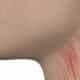Close-up anatomical illustration of the lower face and neck demonstrating the mastoid crevasse technique, highlighting the platysma and deeper structural support points used to restore jawline definition and neck contour.