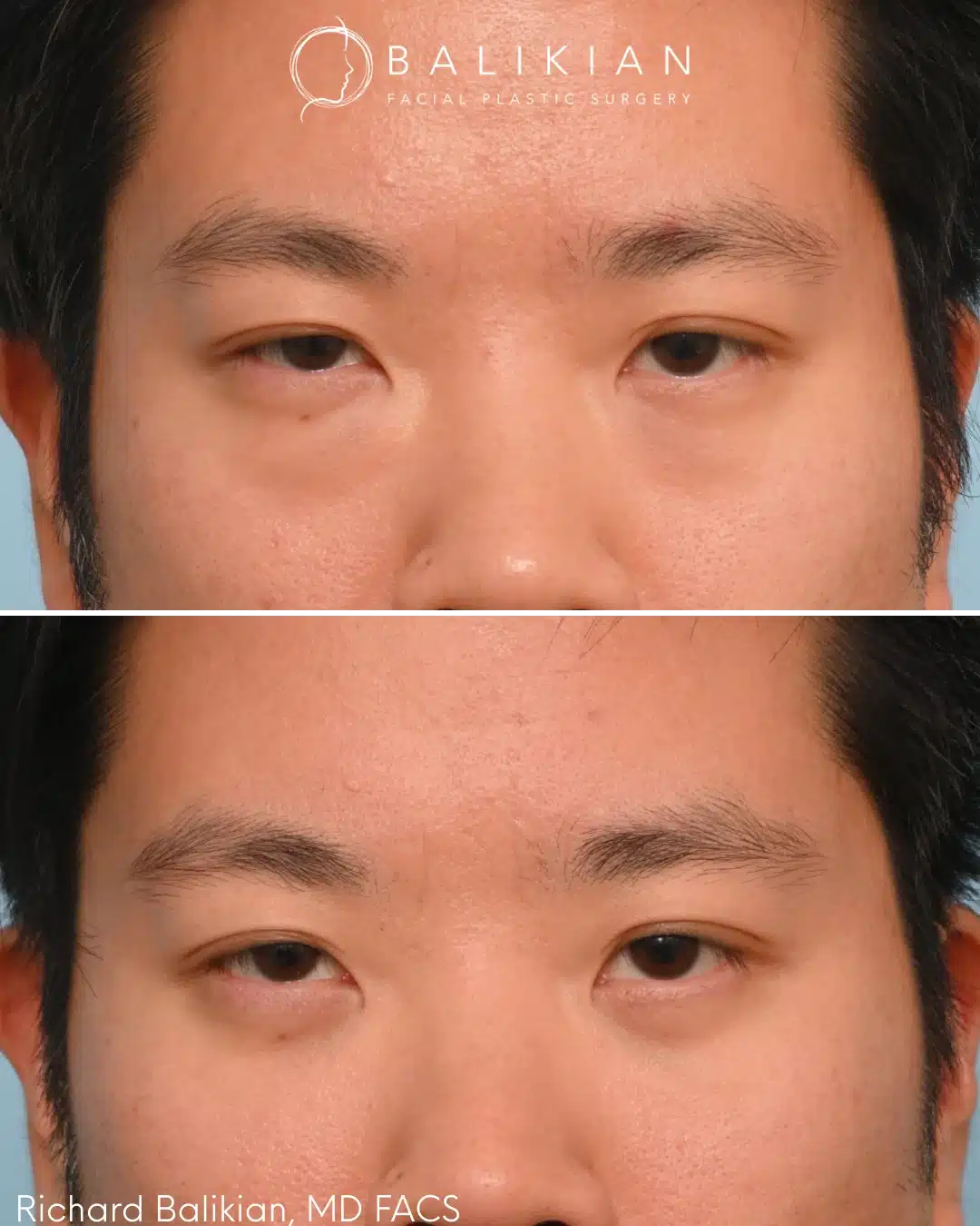 Lower eyelid surgery softens under eye fullness, creating a more even and rested appearance. Lower eyelid surgery before and after front view Asian male with reduced under eye fullness and smoother contour