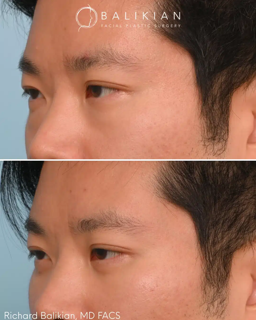 Lower eyelid surgery before and after left oblique view Asian male with less under eye puffiness