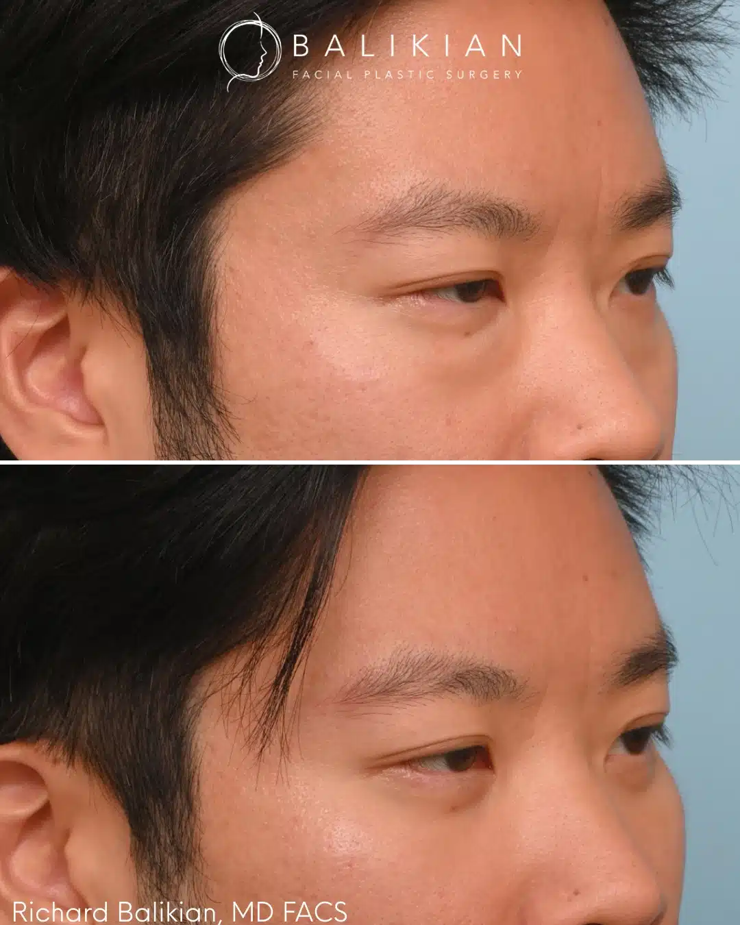Lower eyelid surgery before and after right oblique view Asian male showing improved under eye contour