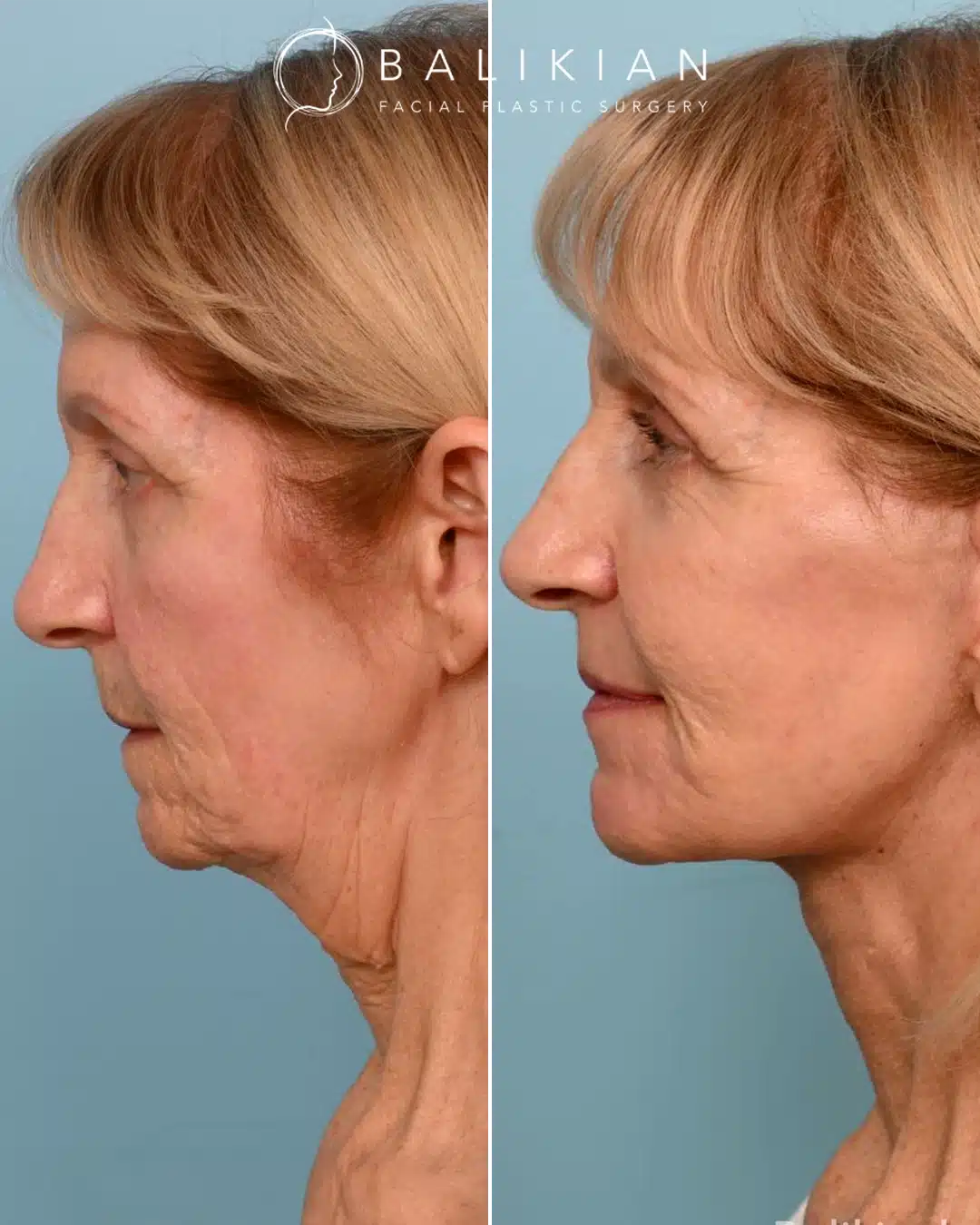 Side profile before and after showing smoother neckline and refined jawline contour