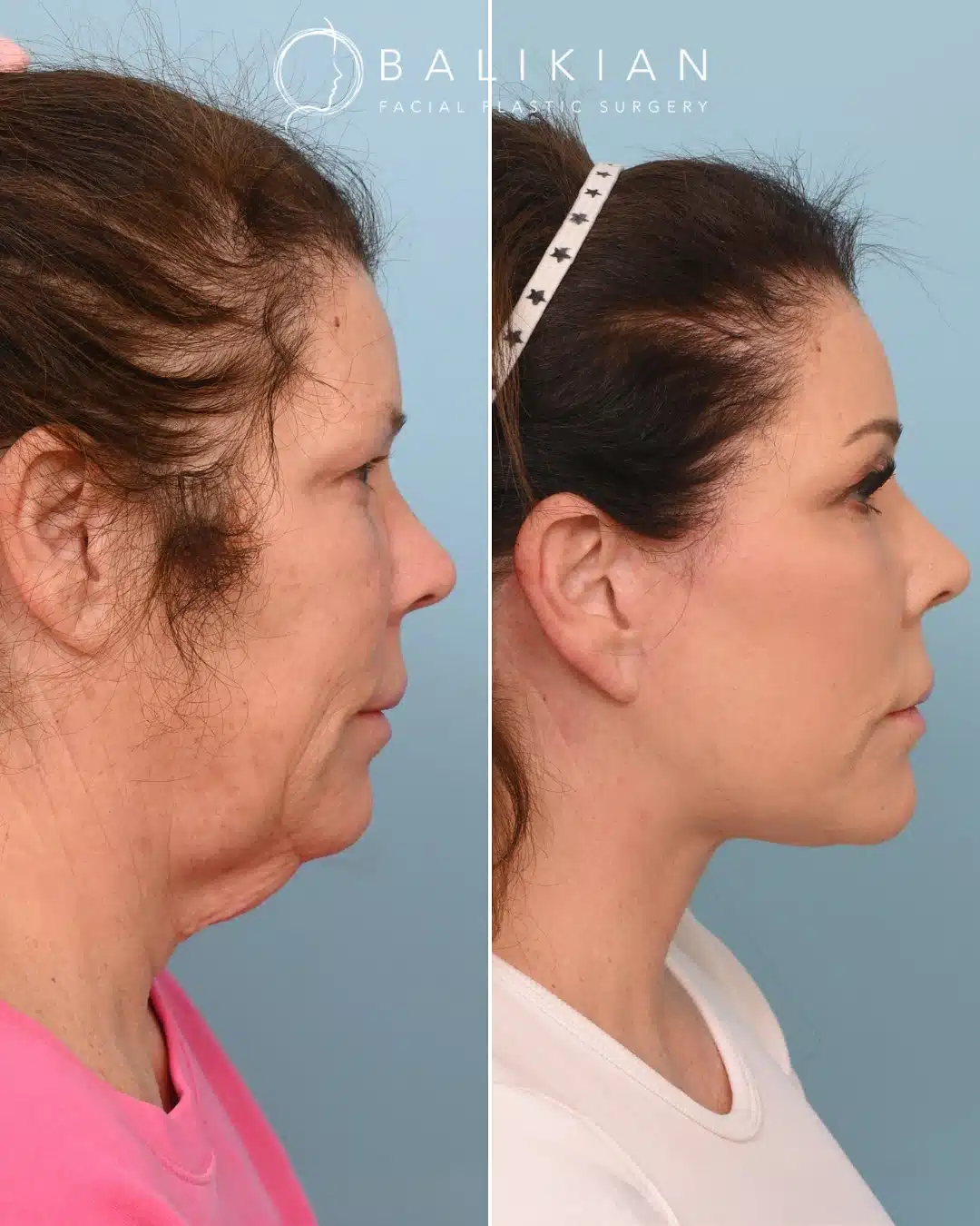 Side profile before and after with improved neck contour and jawline definition