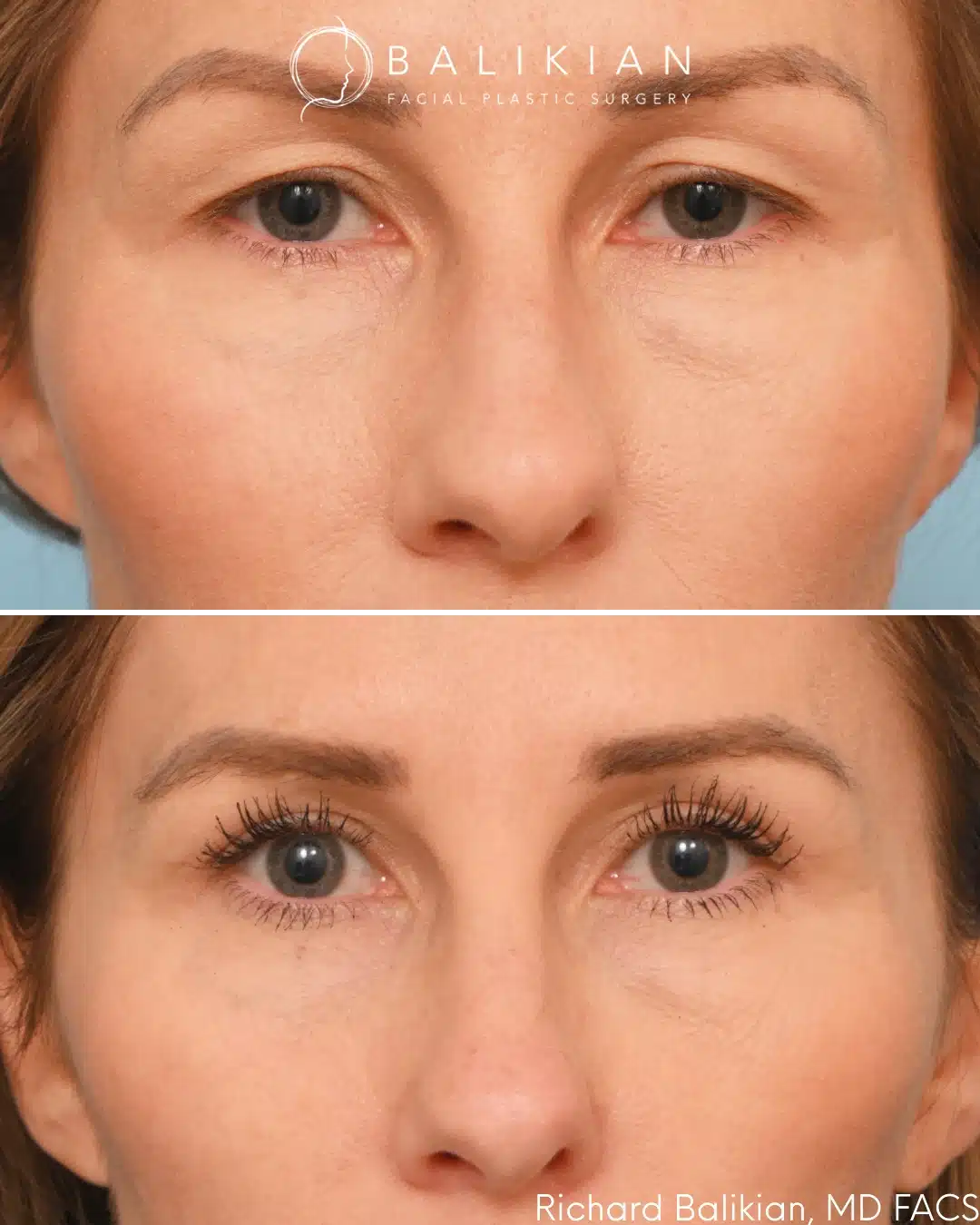 Excess upper eyelid skin is removed, allowing the eyes to appear more open and naturally refreshed. Upper eyelid blepharoplasty before and after front view with a more open eye appearance and reduced heaviness