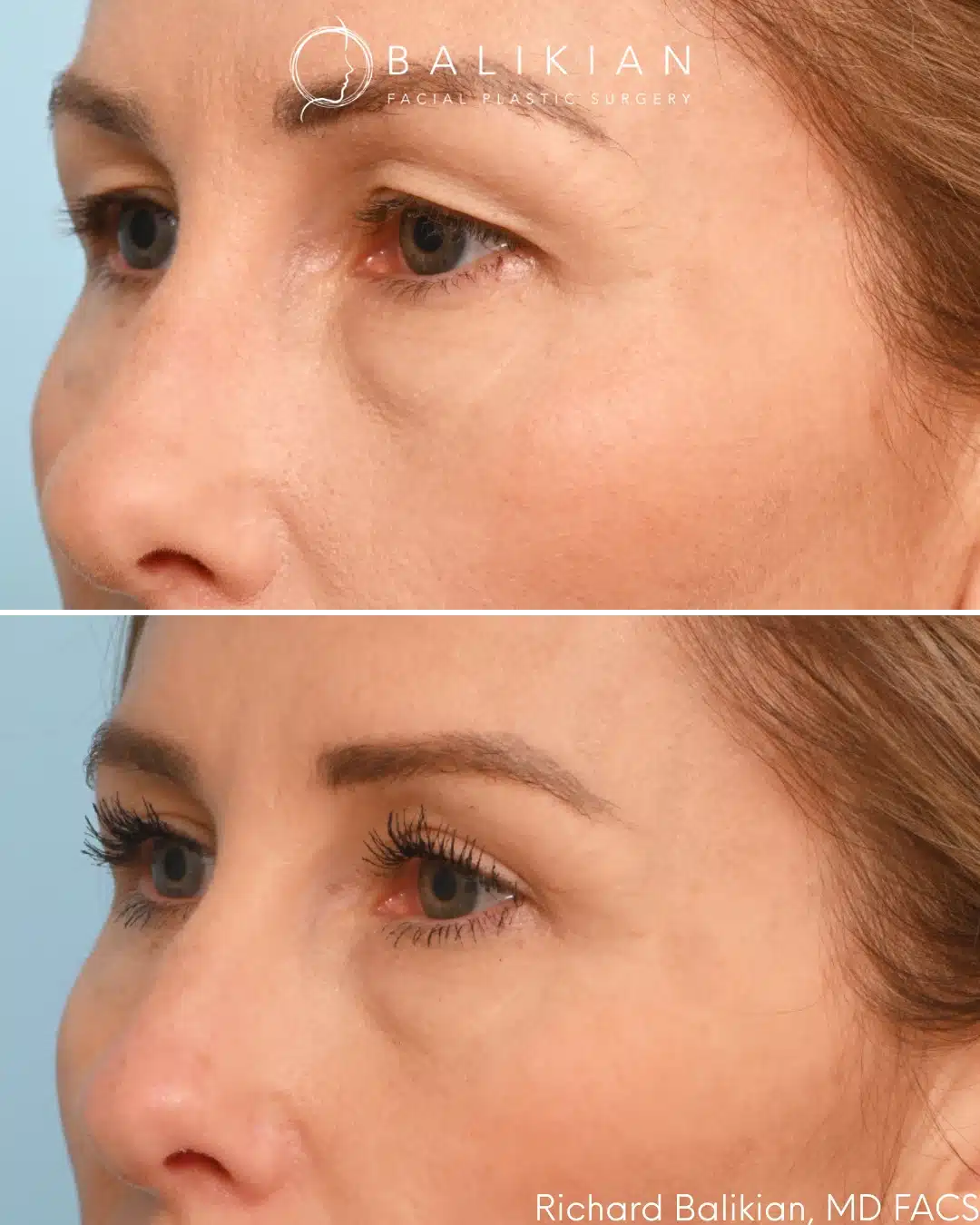 Upper eyelid blepharoplasty before and after left oblique view showing smoother eyelid contour and improved crease
