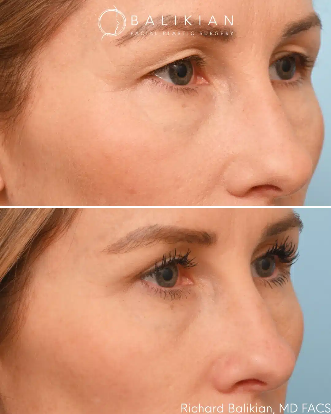 Upper eyelid blepharoplasty before and after right oblique view with improved eyelid shape and definition