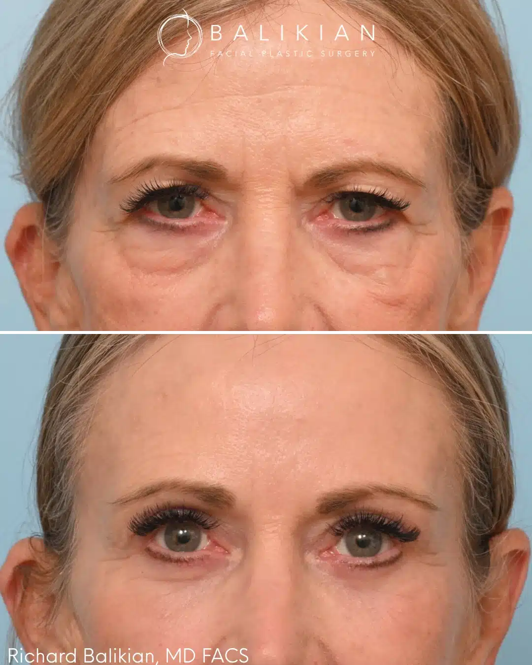 Upper and lower eyelid blepharoplasty before and after front view with brighter eyes and smoother under eye area