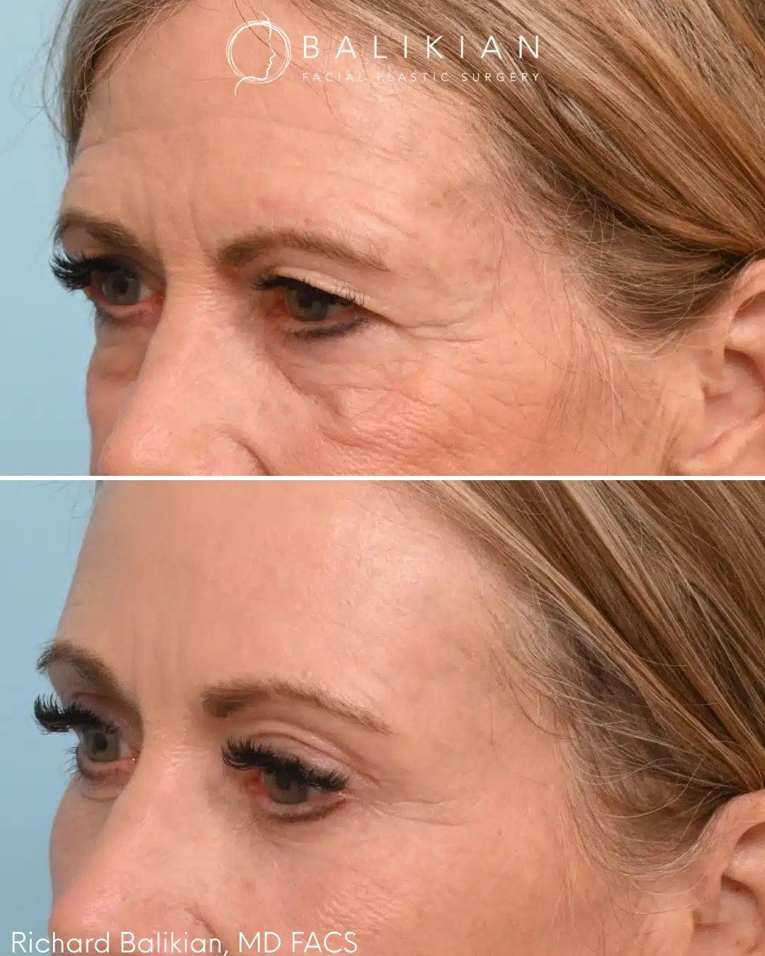 Upper and lower eyelid blepharoplasty before and after left oblique view improving under eye contour and eyelid position