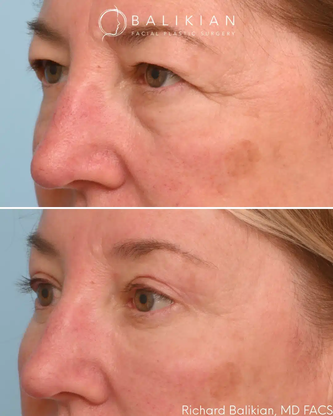 Eyelid surgery before and after left oblique view with smoother lower eyelid and improved definition