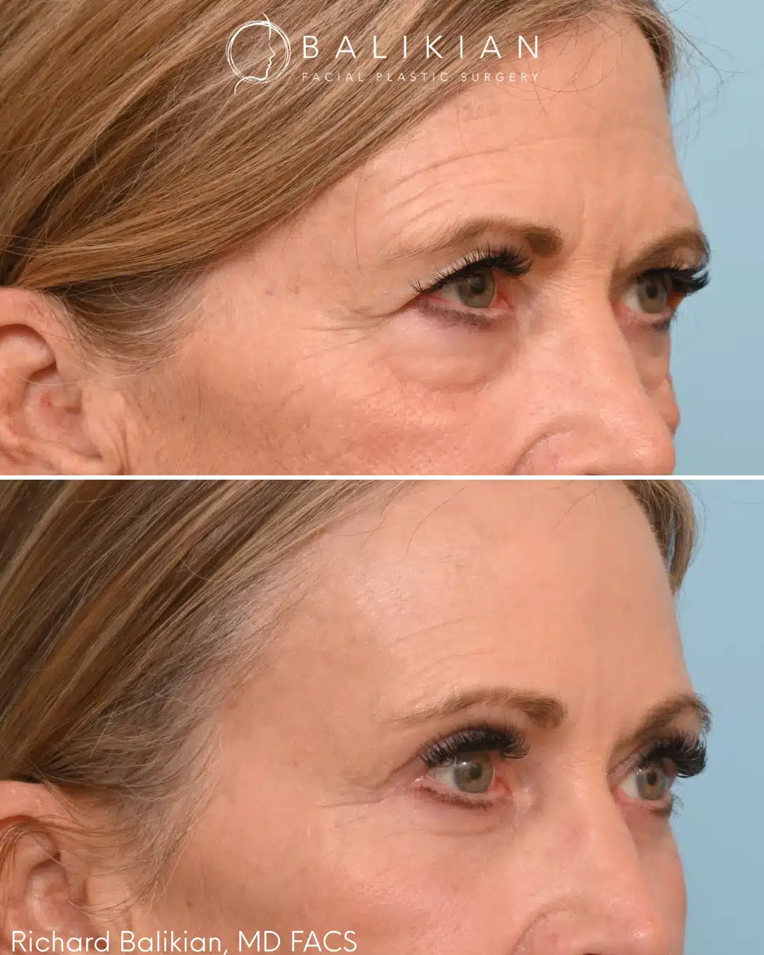 Upper and lower eyelid blepharoplasty before and after right oblique view with smoother transition under the eyes