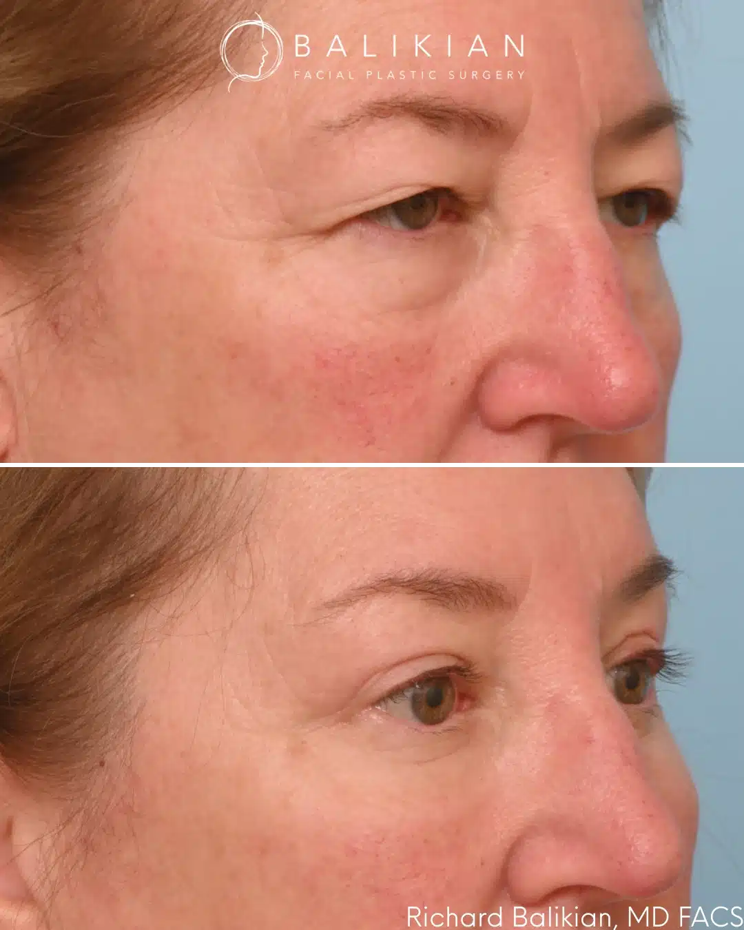 Eyelid surgery before and after right oblique view reducing under eye bags and refining eyelid shape