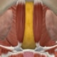 Anatomical illustration of the neck showing the platysma muscles, subplatysmal fat, and deeper structural layers involved in neck contour and aging.