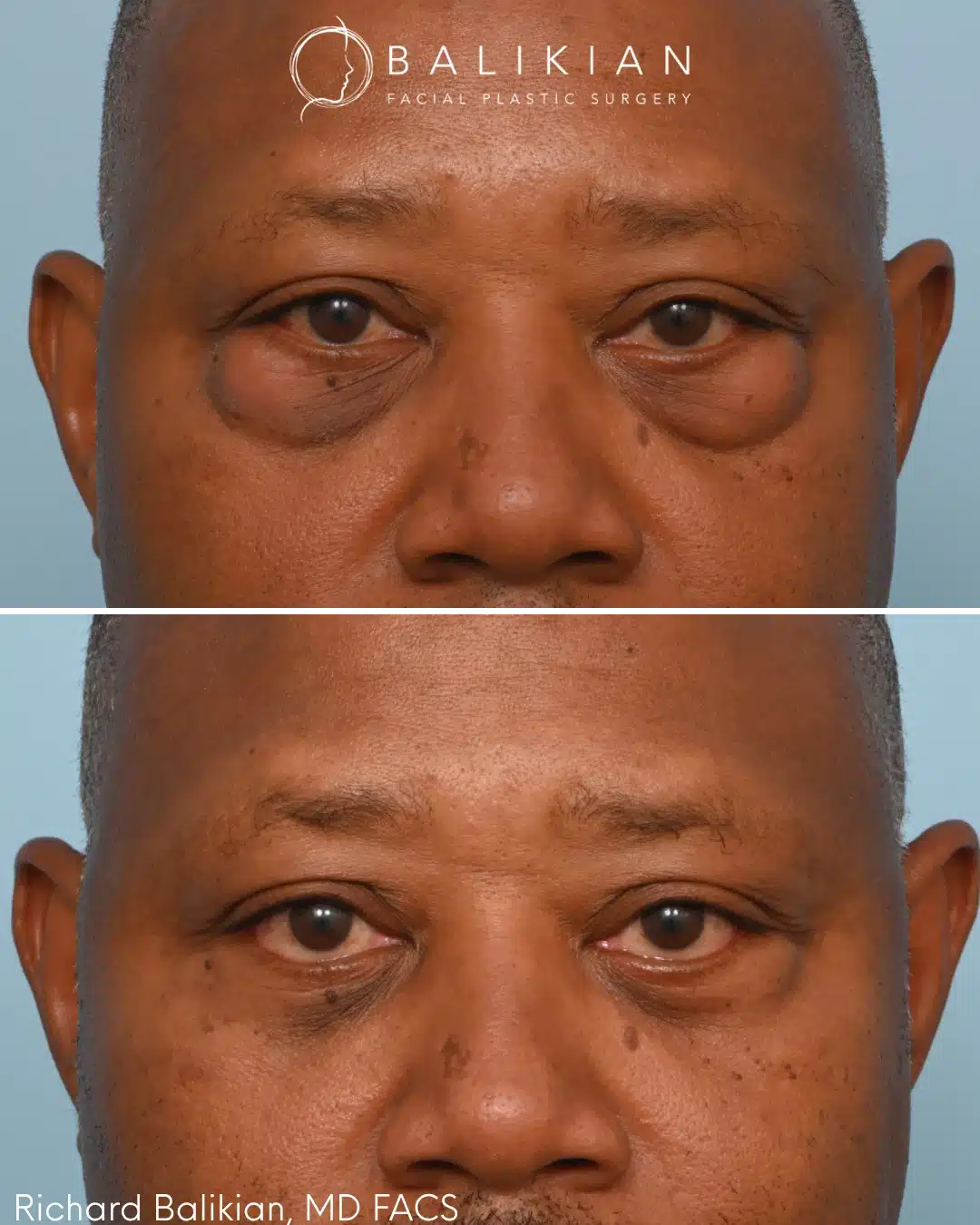 Male lower blepharoplasty before and after front view demonstrating reduction of under-eye bags and improved lower eyelid contour with a refreshed natural look.