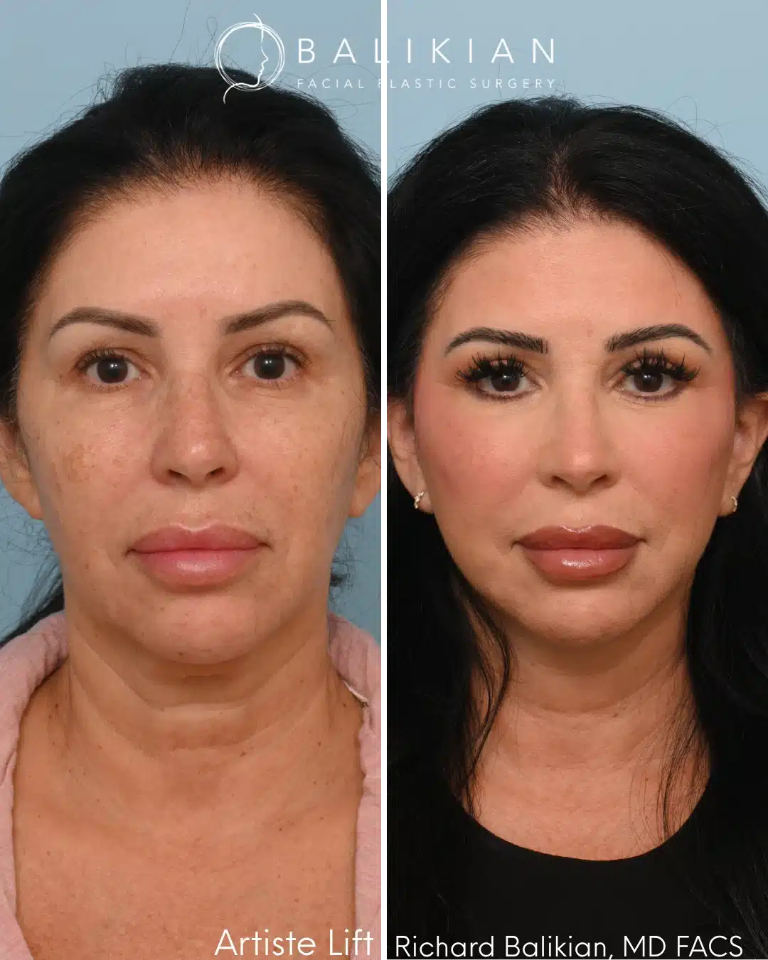 Before and after Artiste Lift™ preservation deep plane facelift in a 53-year-old woman with improved jawline definition, lifted cheeks, and a naturally refreshed appearance.