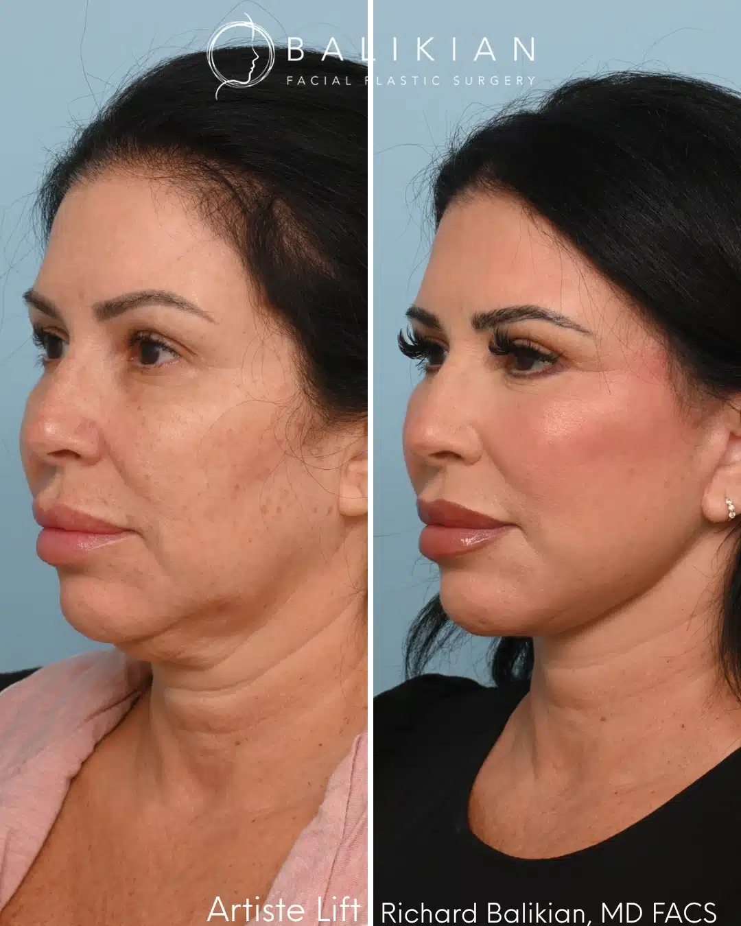 Before and after Artiste Lift™ preservation deep plane facelift in a 53-year-old woman with improved jawline definition, lifted cheeks, and a naturally refreshed appearance.