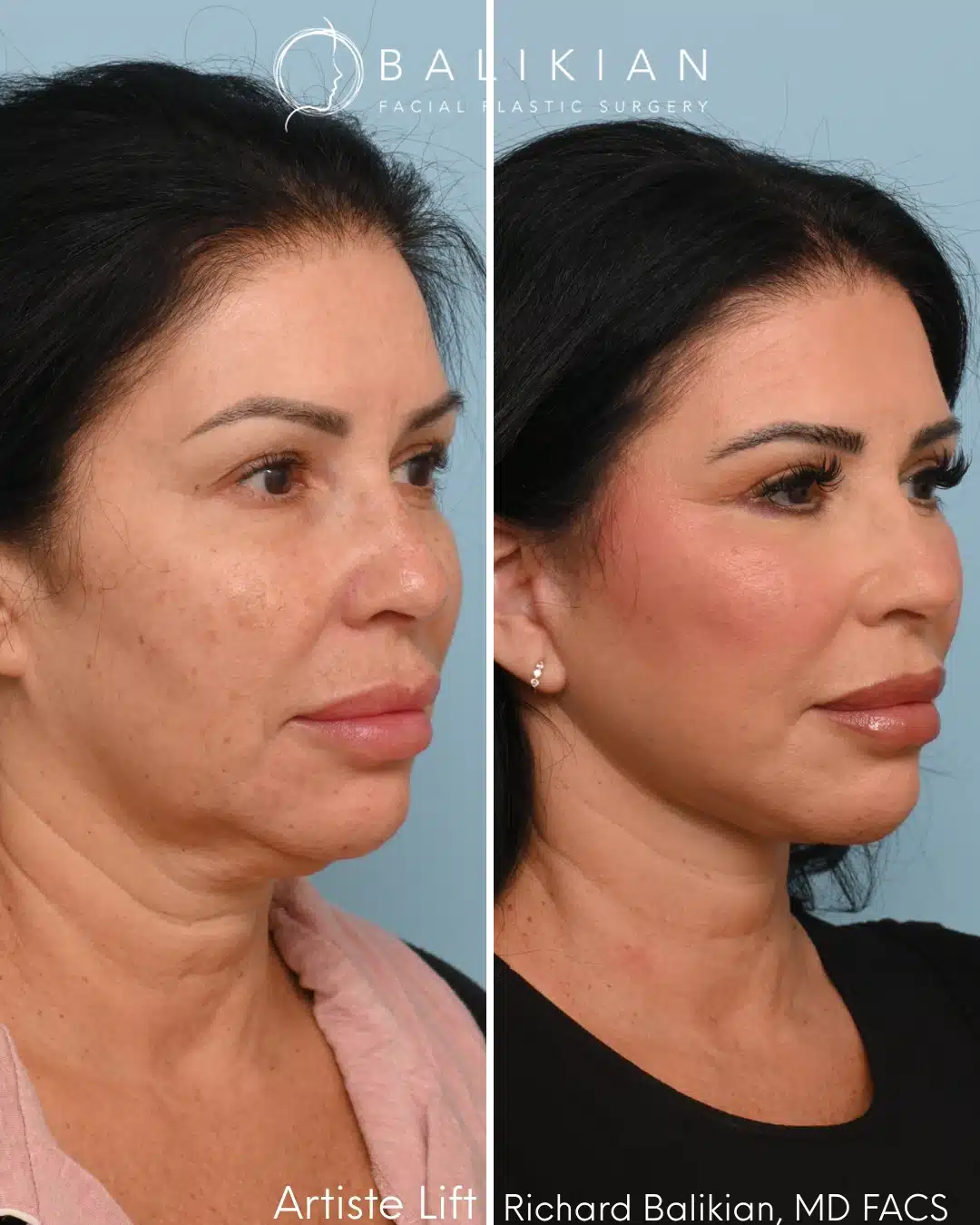 Before and after Artiste Lift™ preservation deep plane facelift in a 53-year-old woman with improved jawline definition, lifted cheeks, and a naturally refreshed appearance.