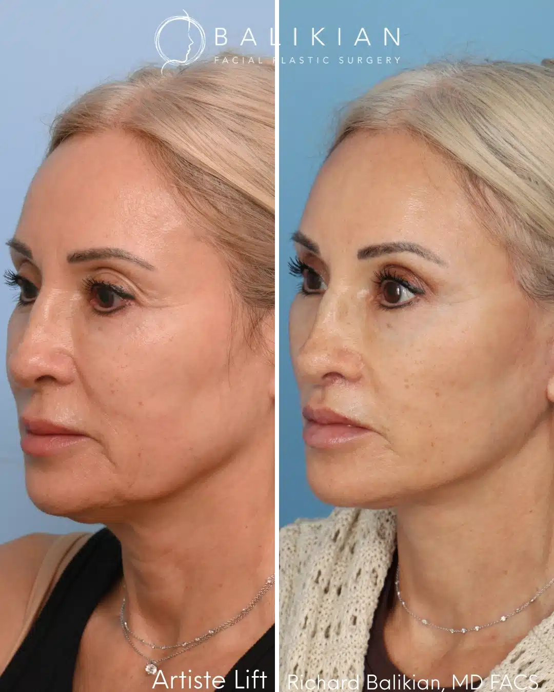 Before and after Artiste Lift™ preservation deep plane facelift in a 58-year-old woman demonstrating a refreshed appearance with improved cheeks, jawline, and neck definition.