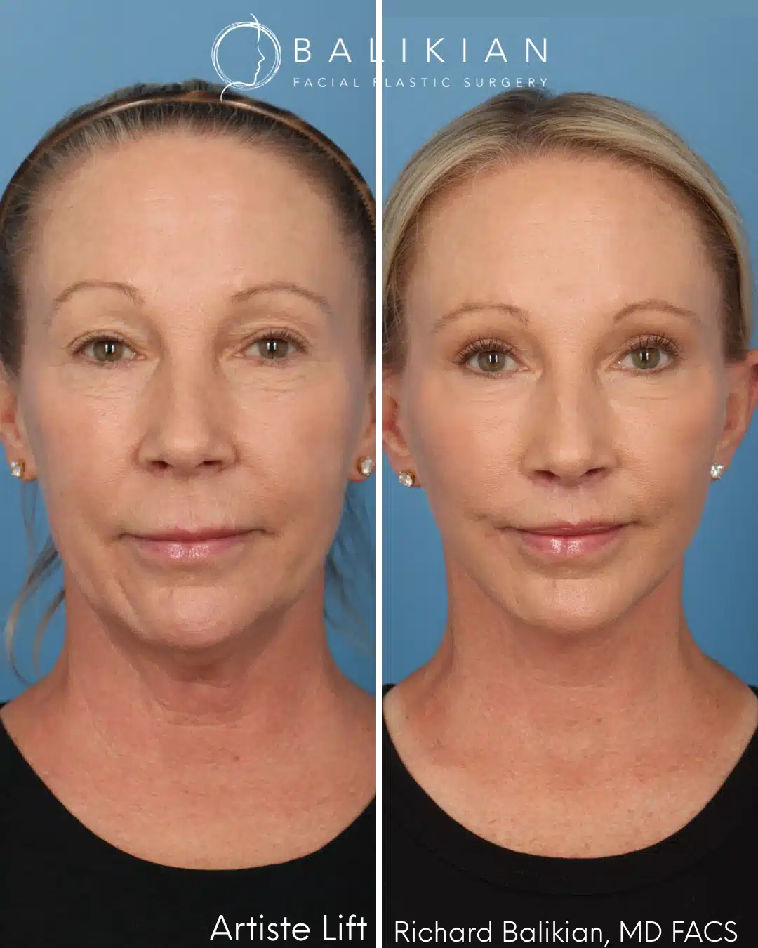 Before and after Artiste Lift™ preservation deep plane facelift in a 57-year-old woman showing natural facial rejuvenation, improved jawline definition, lifted cheeks, and a smoother neck contour.