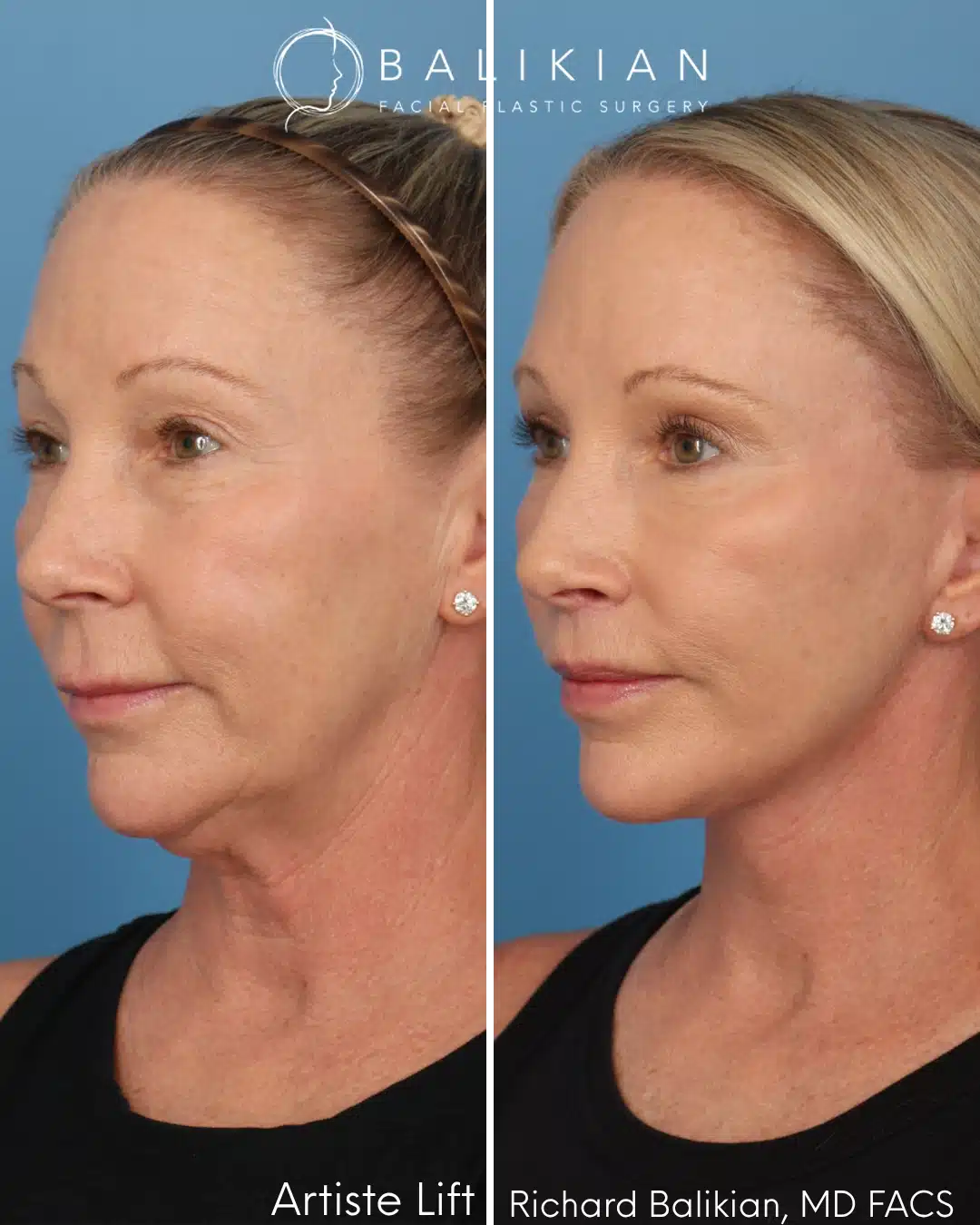 Before and after Artiste Lift™ preservation deep plane facelift in a 57-year-old woman showing natural facial rejuvenation, improved jawline definition, lifted cheeks, and a smoother neck contour.