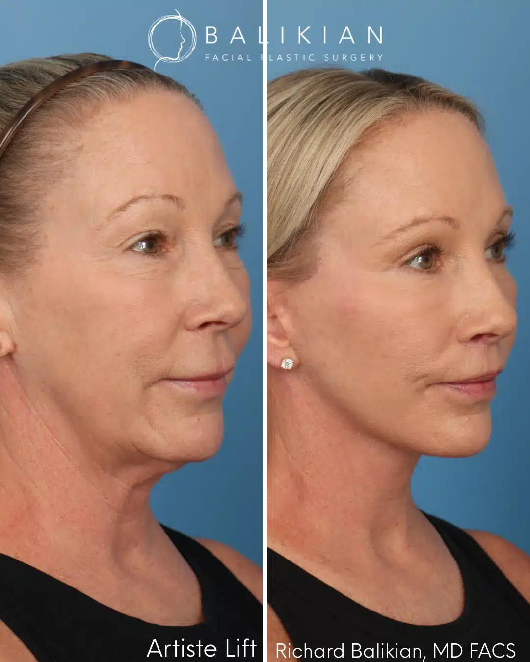Before and after Artiste Lift™ preservation deep plane facelift in a 57-year-old woman showing natural facial rejuvenation, improved jawline definition, lifted cheeks, and a smoother neck contour.