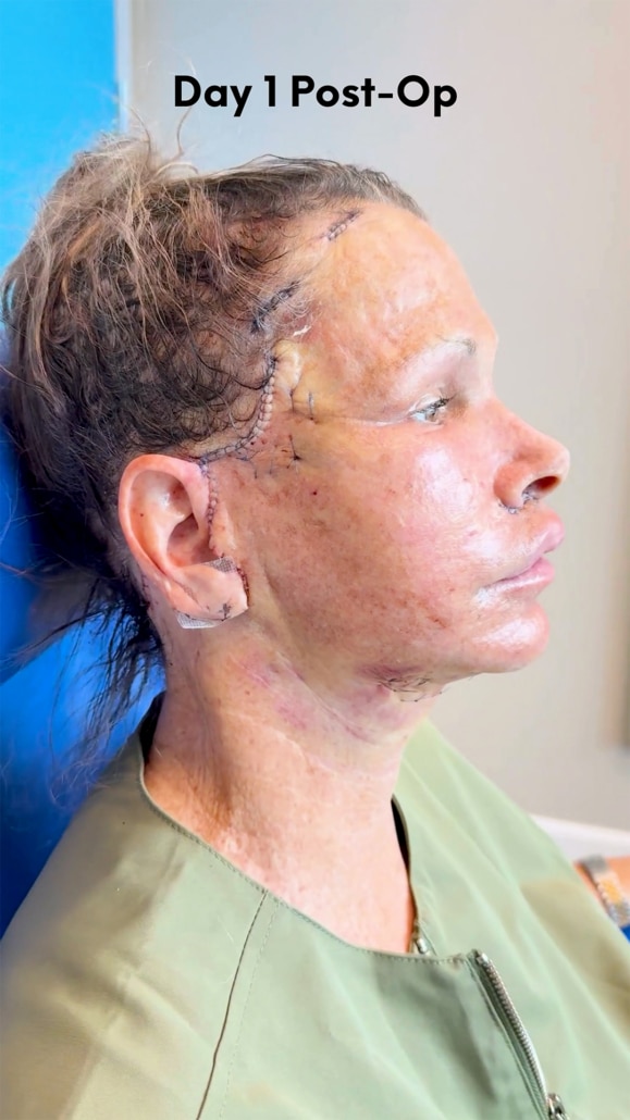Day 1 post-op profile view after preservation deep plane facelift and vertical deep neck lift showing normal swelling and early healing of facelift incisions.