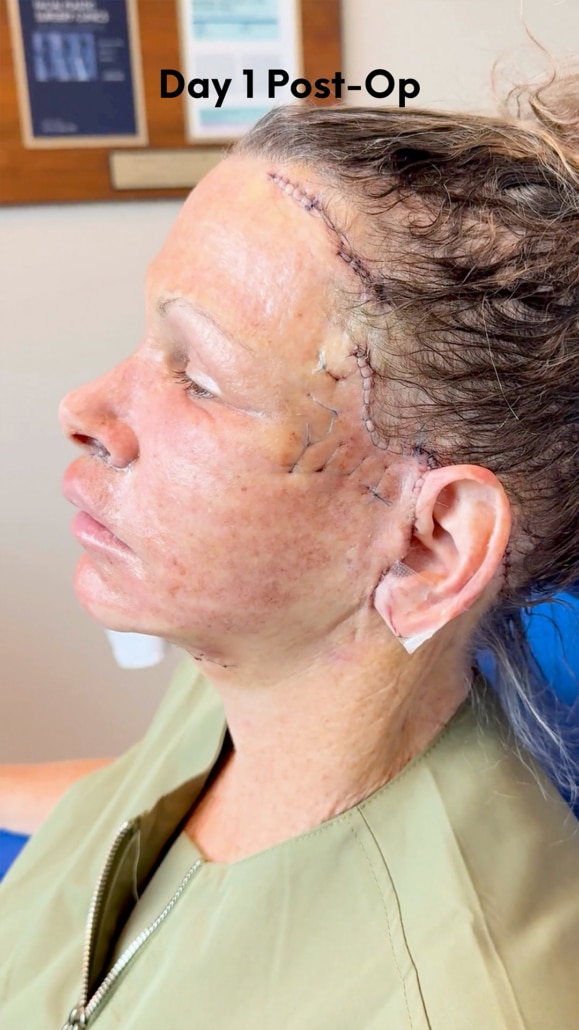 Left profile on Day 1 after Artiste Lift™ Preservation Deep Plane Facelift showing normal postoperative swelling and carefully placed facelift incisions.