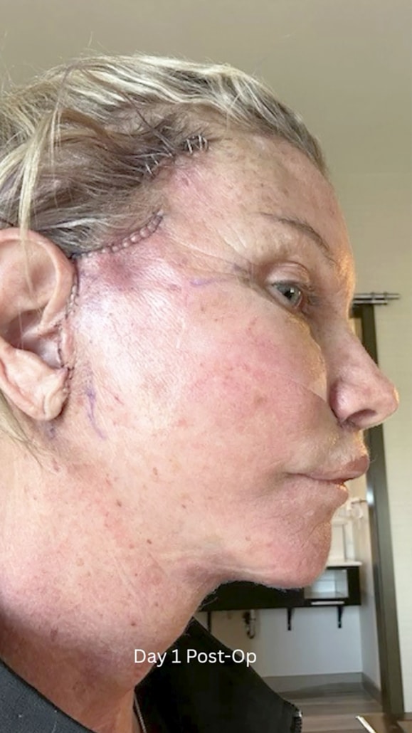 Lee during early facelift recovery showing resolving bruising, improving facial contour, and well-healing incisions around the ear and hairline.
