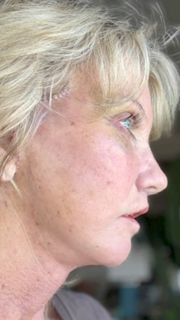 Lee on Day 1 after Artiste Lift™ Preservation Deep Plane Facelift and Vertical Deep Neck Lift showing expected postoperative swelling, bruising, and early healing of facelift incisions.