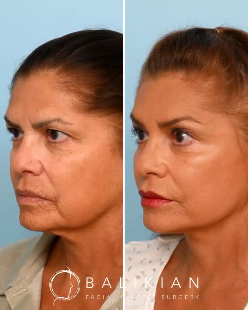 Actual patient before and after a preservation deep plane facelift and brow lift by Dr. Richard Balikian, showing a more defined jawline, smoother neck, and naturally refreshed facial appearance.