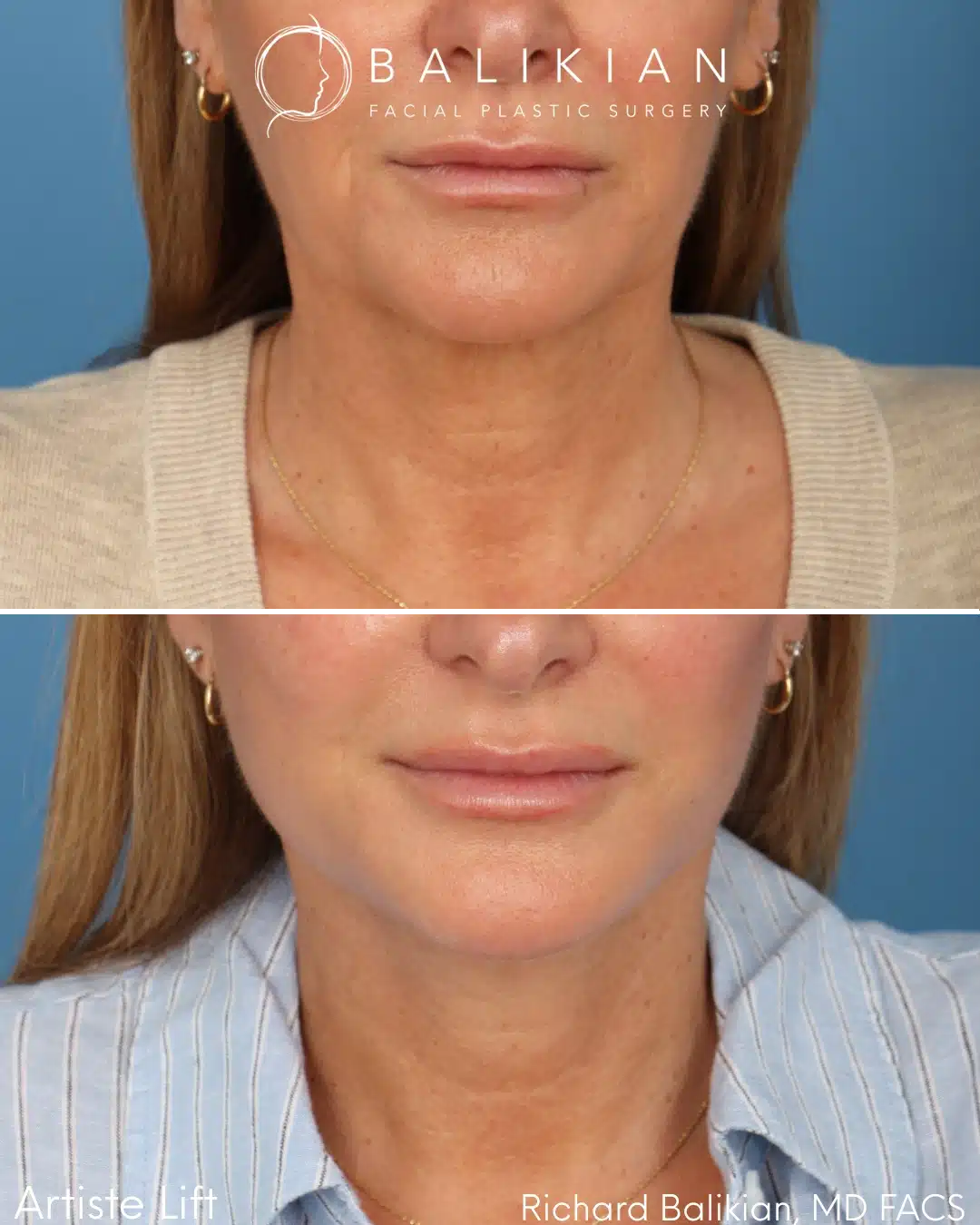 Before and after Deep Vertical Neck Lift with the Artiste Lift™ Preservation Deep Plane Facelift in a 51-year-old woman showing a tighter neck, improved jawline definition, and natural facial rejuvenation.