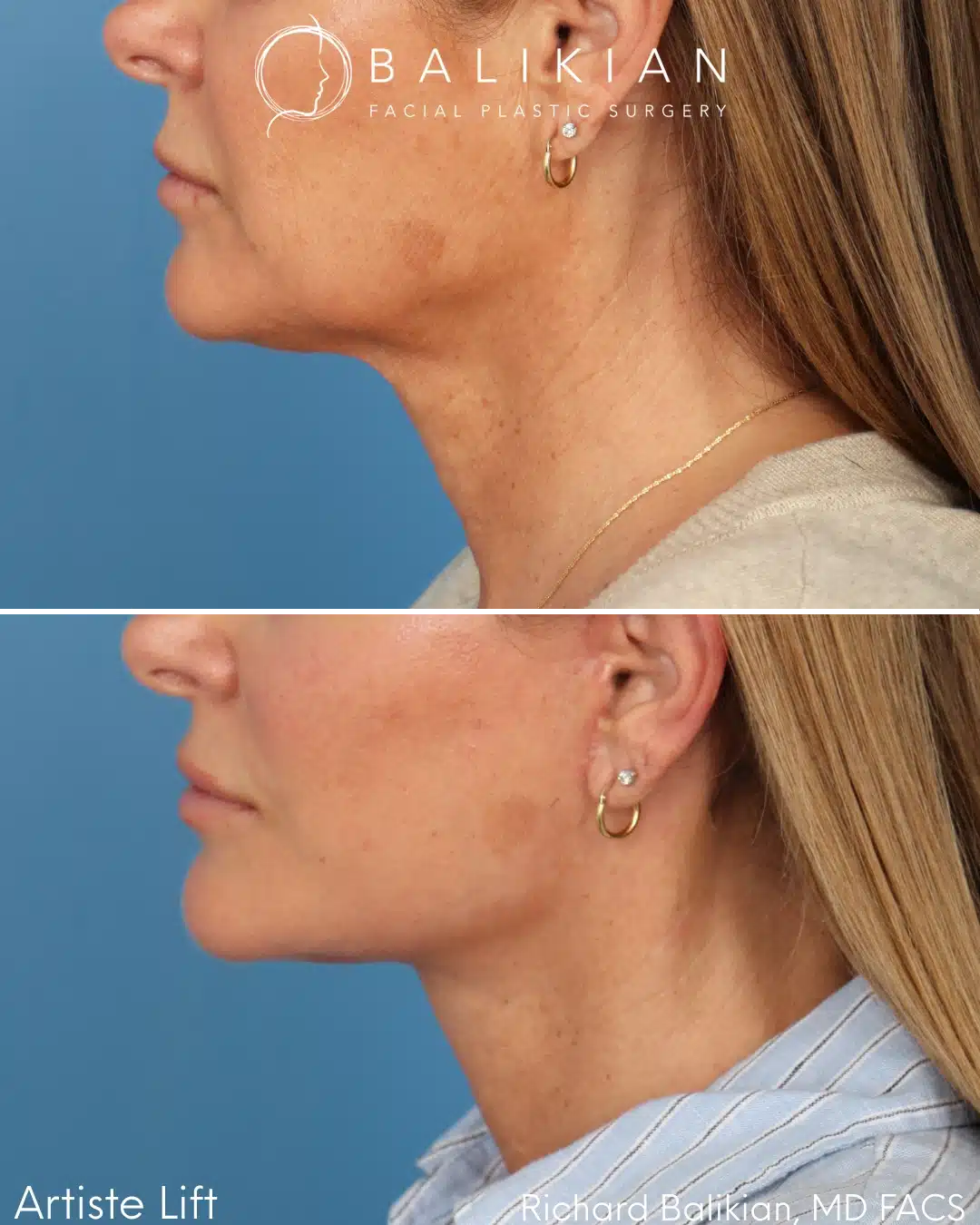 Before and after Deep Vertical Neck Lift with the Artiste Lift™ Preservation Deep Plane Facelift in a 51-year-old woman showing a tighter neck, improved jawline definition, and natural facial rejuvenation.