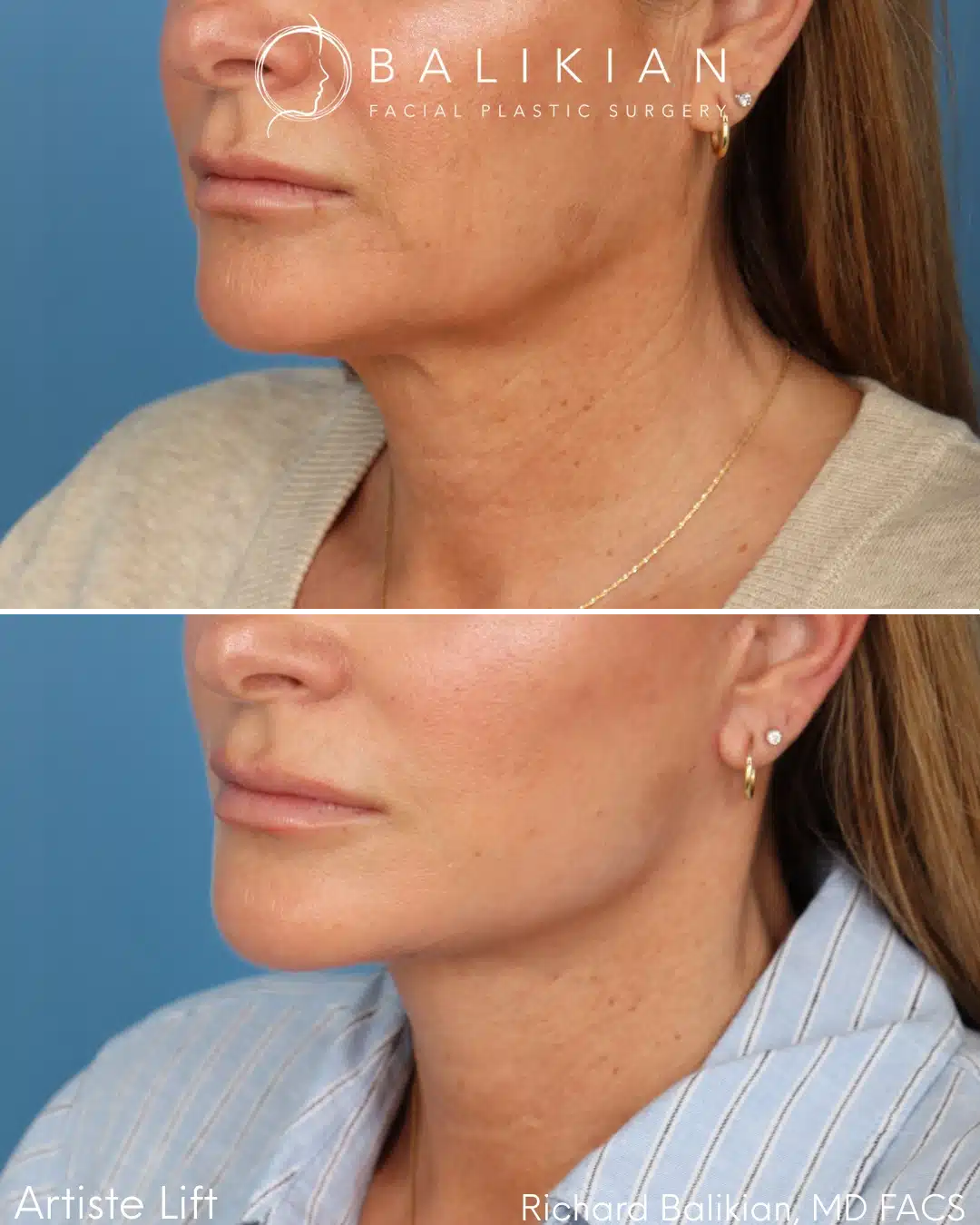 Before and after Deep Vertical Neck Lift with the Artiste Lift™ Preservation Deep Plane Facelift in a 51-year-old woman showing a tighter neck, improved jawline definition, and natural facial rejuvenation.