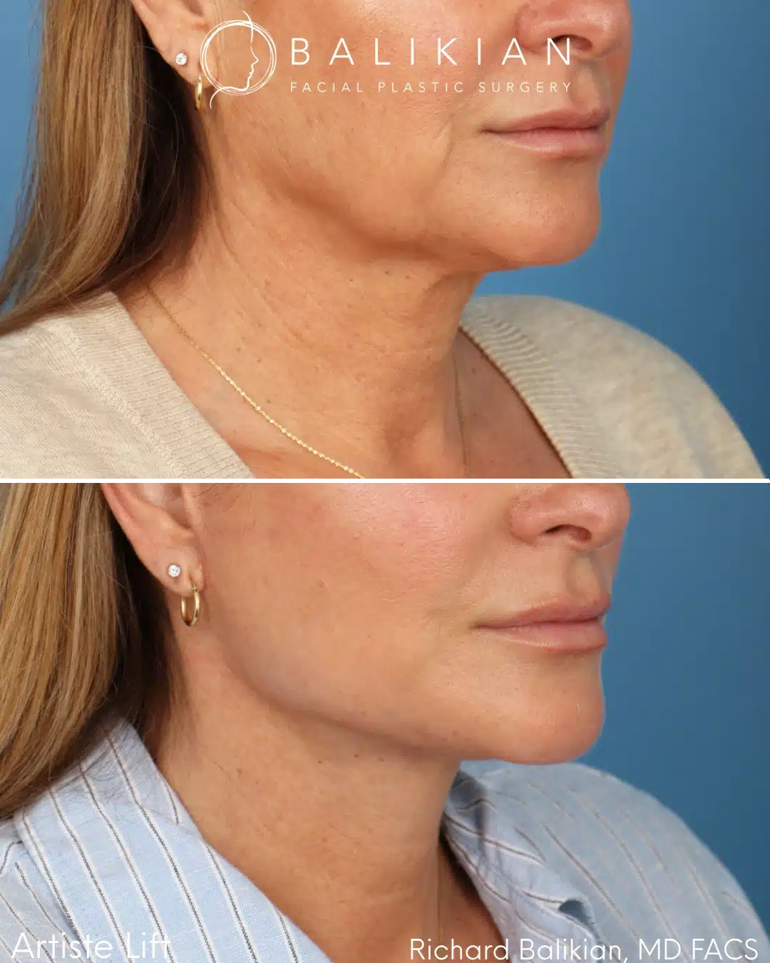 Before and after Deep Vertical Neck Lift with the Artiste Lift™ Preservation Deep Plane Facelift in a 51-year-old woman showing a tighter neck, improved jawline definition, and natural facial rejuvenation.