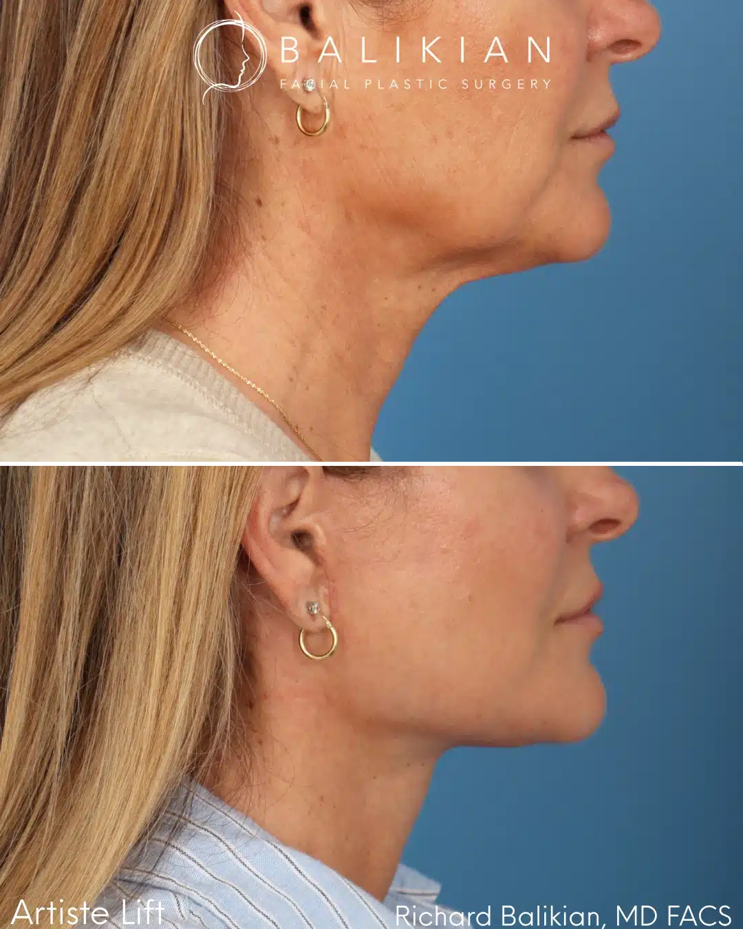 Before and after Deep Vertical Neck Lift with the Artiste Lift™ Preservation Deep Plane Facelift in a 51-year-old woman showing a tighter neck, improved jawline definition, and natural facial rejuvenation.